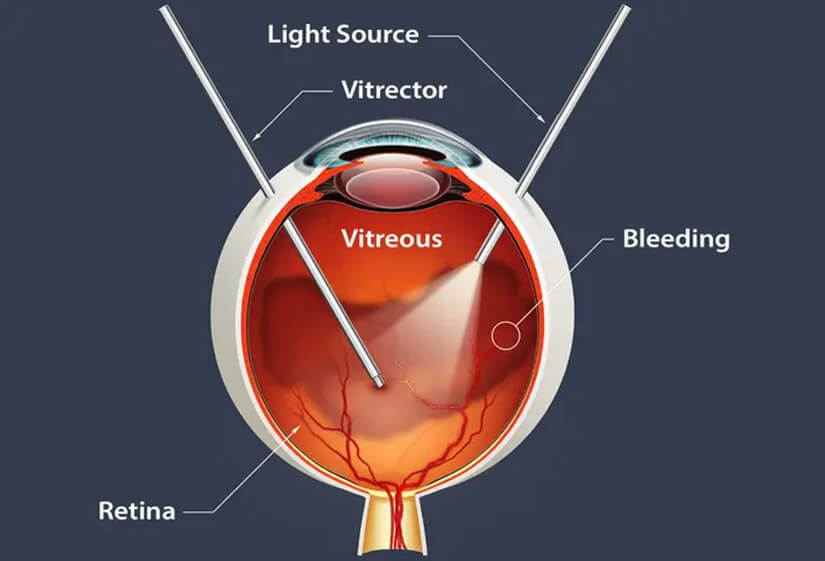 retina surgery