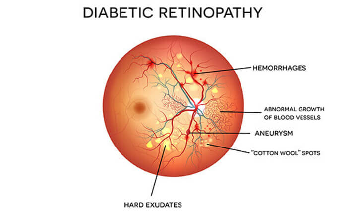diabetic retinopathy