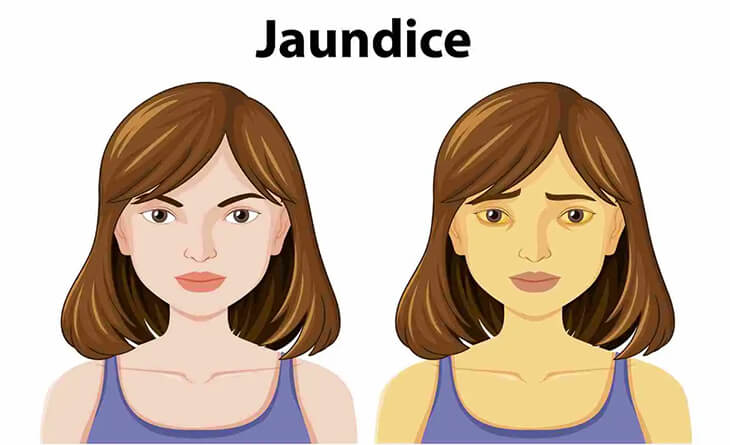 yellow eye treatment