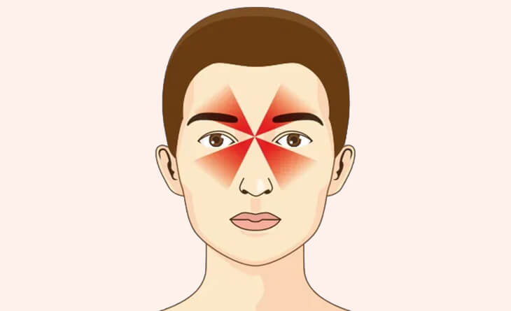Headache Behind the Eyes - Dr Anisha Gupta - Eye Specialist in Delhi -02 Headache Behind the Eyes