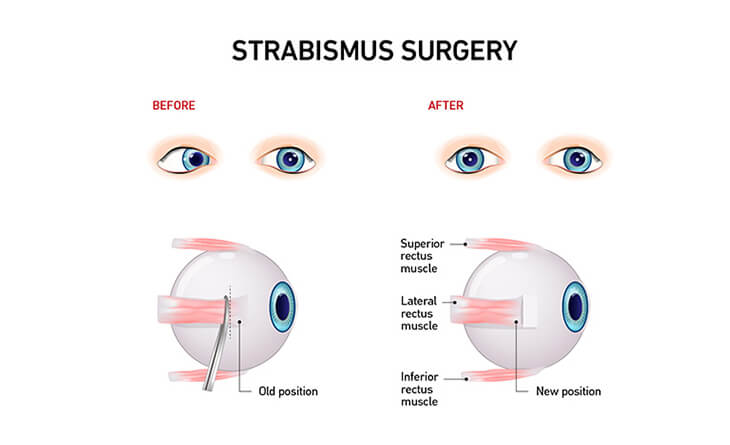 Strabismus Treatment
