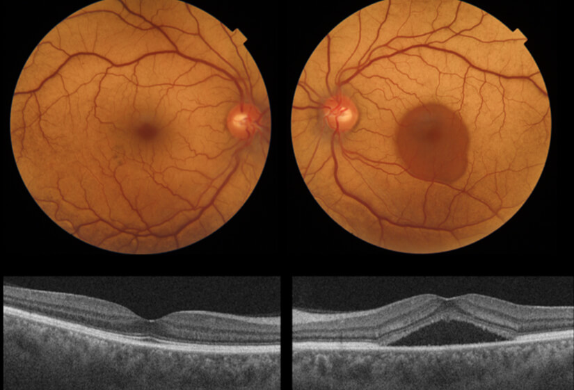 Central Serous Retinopathy Treatment