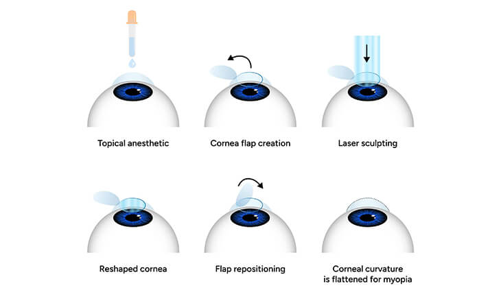 Can Eyesight Go Bad After LASIK Surgery - Dr Anisha Gupta -01 LASIK surgery