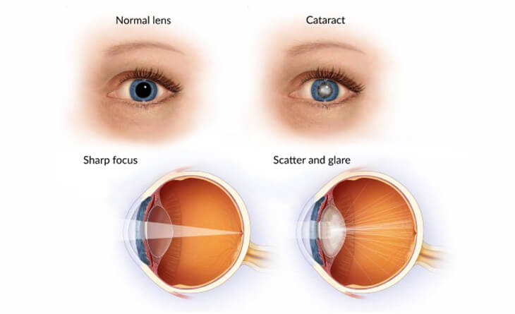 Cataract surgery in Delhi