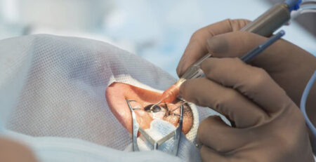 Cataract surgery in Delhi