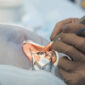 Cataract surgery in Delhi